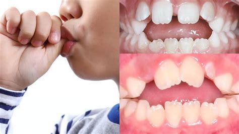 Teeth From Sucking Thumb