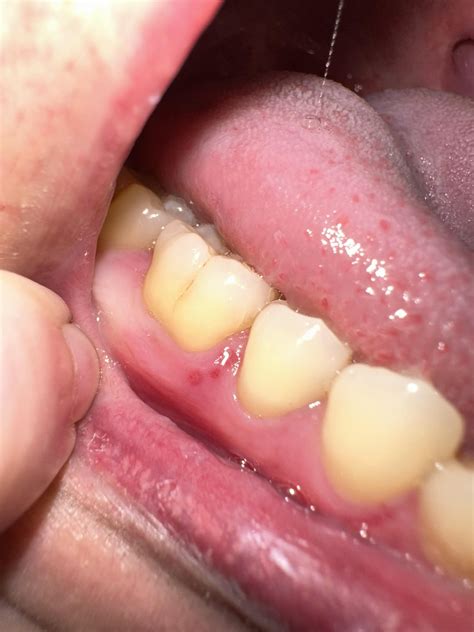 Red Spot On Gums