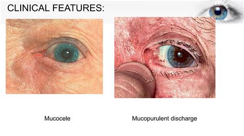 CHRONIC DACRYOCYSTITIS.pptx
