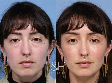 Fat Transfer Before And After | L&P Aesthetics