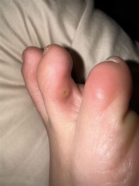 White Growth Between Toes