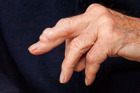 Ganglion cyst – causes, symptoms and treatment | healthdirect