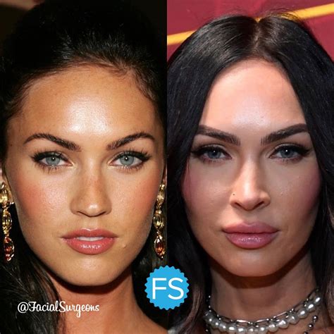 Megan Fox Plastic Surgery Before And After