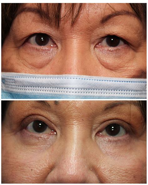 Eyelid Surgery | Pacific Eye Surgeons