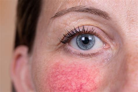 Does Laser Treatment Work For Rosacea