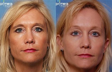 Endoscopic Brow Lift Houston at Tina Lown blog