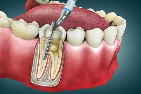 Root Canal Recovery Care: Essential Tips for Effective Healing