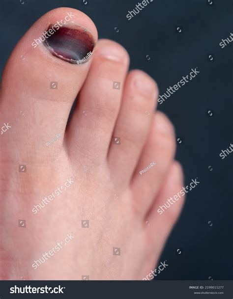 Bruised Toe Nail