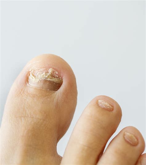 Using Dental Floss For Ingrown Toenail at Zoe Szabados blog