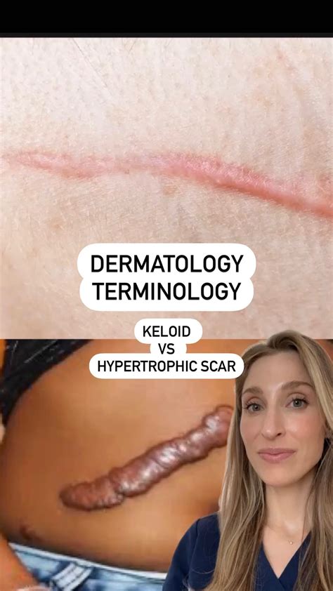 Hypertrophic Scar Vs Keloid