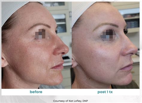 Get the Younger Look You’ve Always Wanted With Opus Plasma! — About Faces Cosmetic Surgery and ...