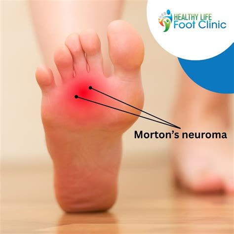 Understanding Morton's Neuroma