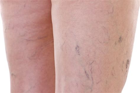 Are Varicose Veins Dangerous? Benign vs Serious Signs Explained