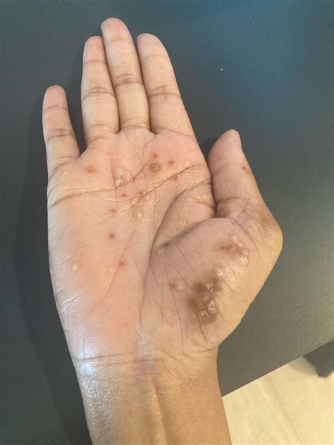 Anti centromere antibodies : r/Autoimmune