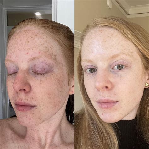 [Before & After] 2 months application of Vitamin C + gentle exfoliation has transformed my skin ...