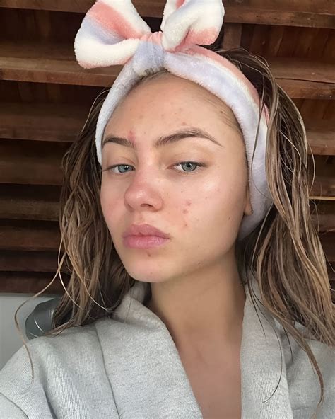 Skin purging: what it is, how long it lasts, and how to manage it - nss G-Club - why does This Happen Meme
