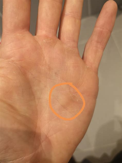 Lump on palm - makes snatches very uncomfortable : r/kettlebell