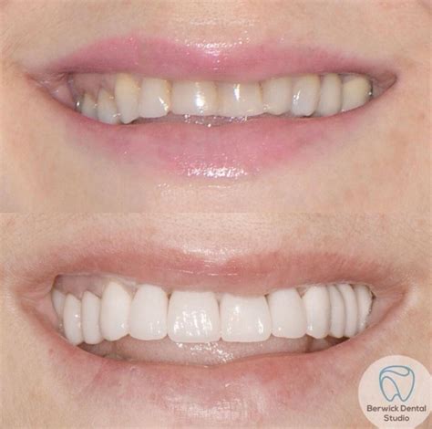 Porcelain Veneers For Missing Teeth at John Pavon blog