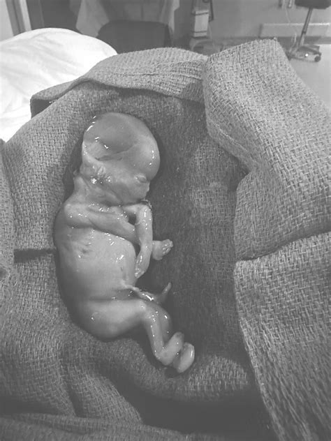 Miscarriage By Week Doctors Diagnosing Miscarriage 'too Early'