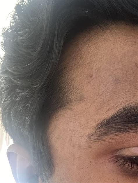Little Bumps on Forehead : r/DermatologyQuestions