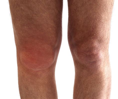 Swelling In Knee