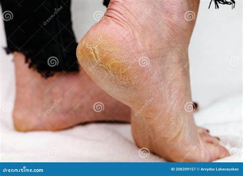 Feet Cracked And Painful at Dennis Fleming blog