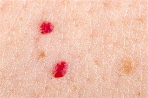 Red Moles On Skin