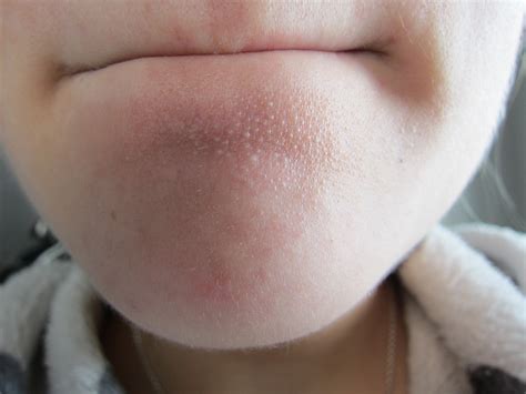 What Is White Bumps On Face at Makayla Sleath blog