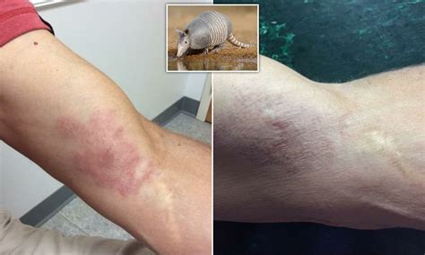 Armadillo Disease Brazil Has A Leprosy Problem, And Armadillos Are