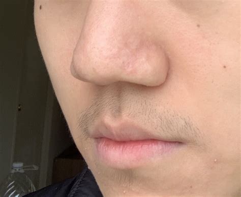 Hypertrophic Acne(bumps) scars on my nose, – Acne – Acne.org Forum