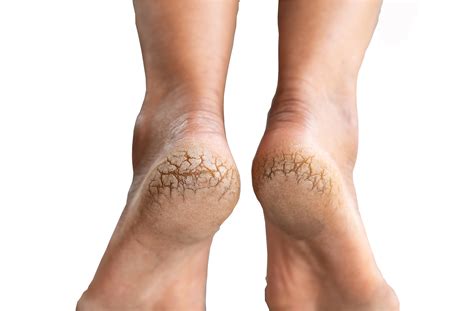 Cracked Heels - What Are They & How Do We Treat - The Healthcare Hub