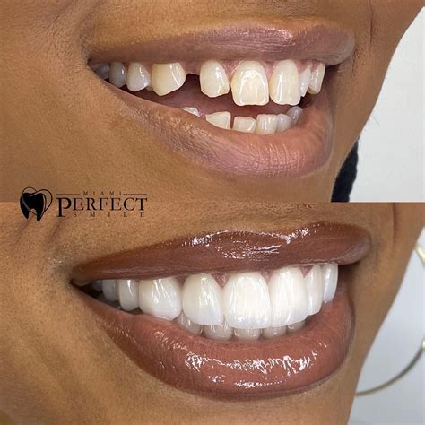 Porcelain veneers before and after by Dr. Helen Carmenate in Miami Cosmetic Dentistry Procedures ...