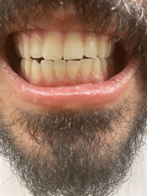 Ortho recommends jaw surgery. Should I do it? I have a misaligned/open ...