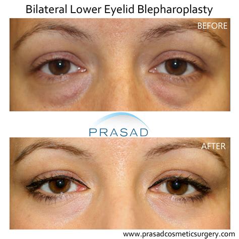 Eye Bag Removal Surgery: Procedure, Risks, Recovery