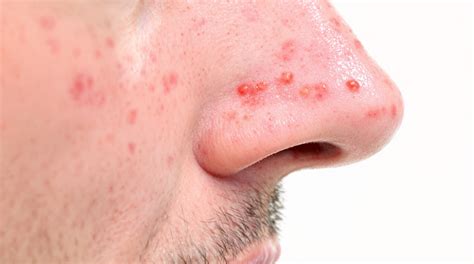 Nasal herpes 👃: how to identify it and get rid of it?