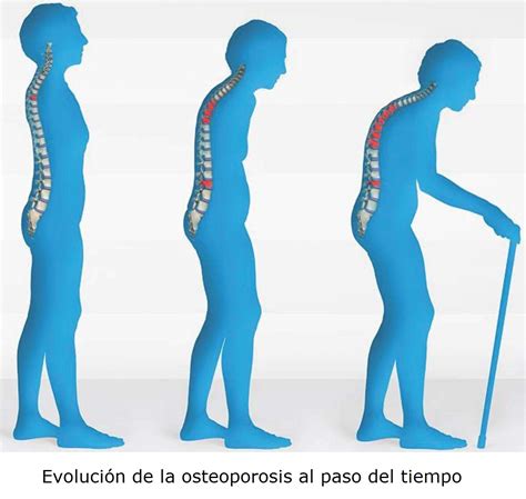 Todo sobre la osteoporosis - Causas, sintomas, tratamientos, prevención...