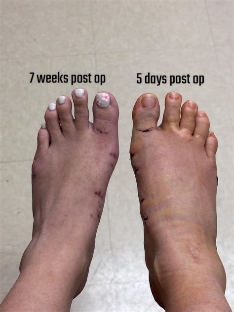 Lapidus Bunionectomy in 3 weeks : r/bunions