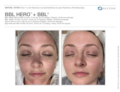 BBL Heroic Photofacial | Hanover, MA | ALDA Aesthetics