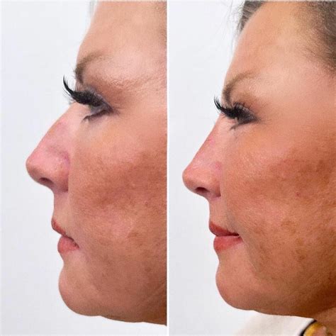 'Dance Moms' Star Abby Lee Miller Gets A Liquid Nose Job