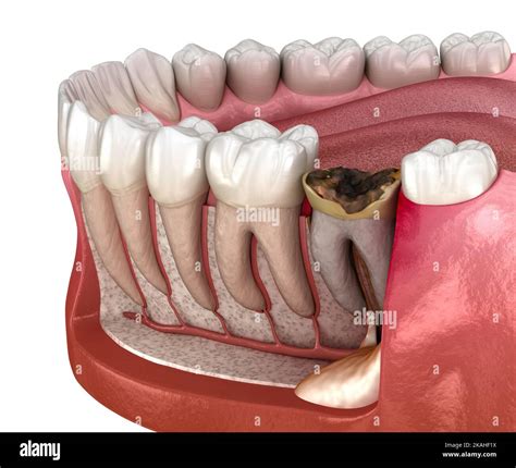 Periostitis tooth - Lump on Gum Above Tooth. Medically accurate dental ...