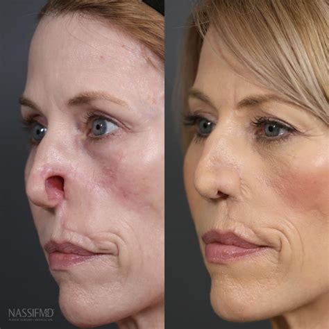 Bad Nose Jobs