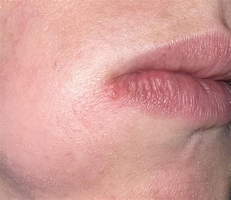 Pimple or cold sore? Started today. Itchy. Already have GHSV-2 no ...