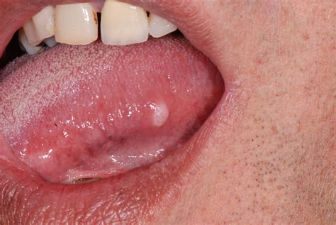 Lump On Tongue Painful