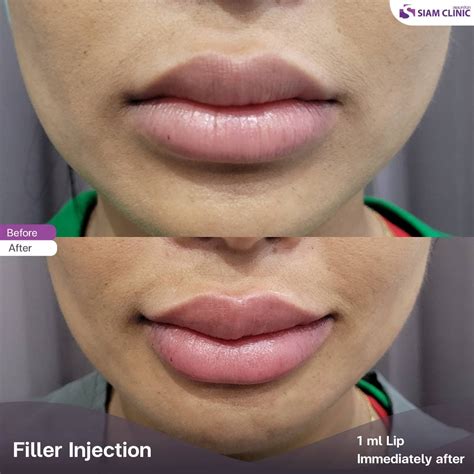 Lip Fillers Before and After Photos - Siam Clinic Thailand