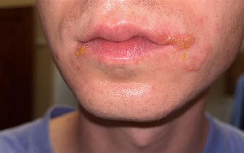 Cold sore or impetigo? : r/DermatologyQuestions