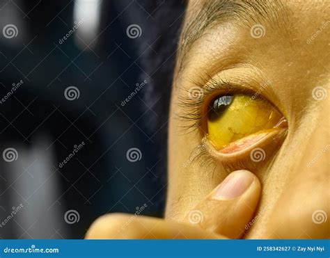 Deep Jaundice in Asian Male Patient. Yellowish Discoloration of Skin and Sclera Stock Image ...