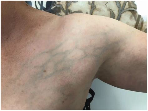 Effort Thrombosis (Paget-Schroetter Syndrome) - Treatment