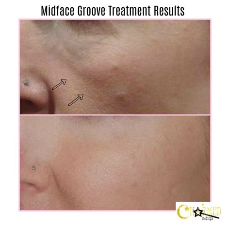 Midface Groove Treatment Results - Charmed Medispa