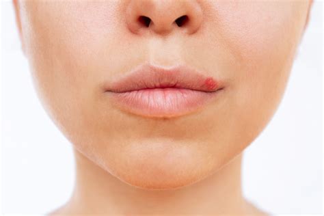 Lip Blemishes: Cold Sores vs. Pimples | Lemonaid Health Healthaid