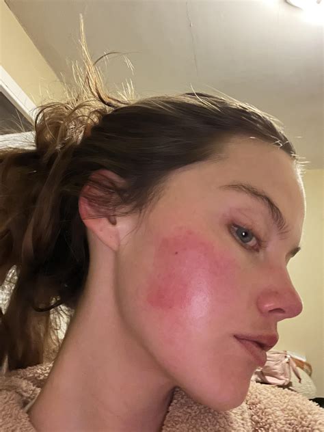 Flushed Cheeks In Adults